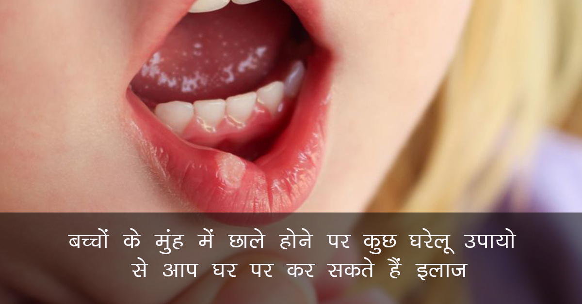 Home Remedies For Mouth Ulcers : बच्चों के मुंह में छाले होने पर कुछ घरेलू उपायो से आप घर पर कर सकते हैं इलाज